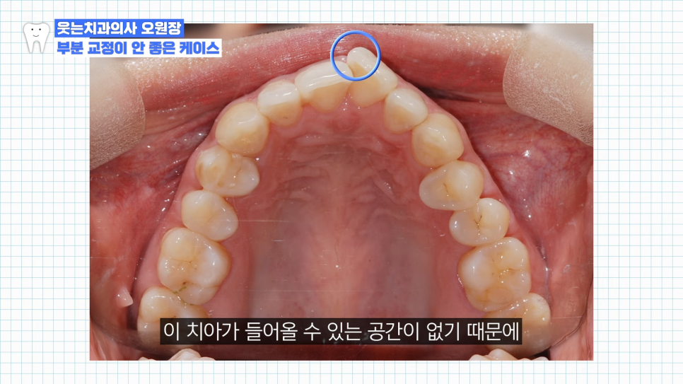 부분교정하고 이렇게 변했습니다 교정 전후 비교 관련 이미지 13