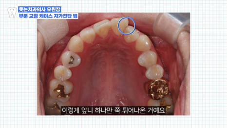 치아교정 앞니부분교정 가능할까? <전문의 답변> 관련 이미지 5