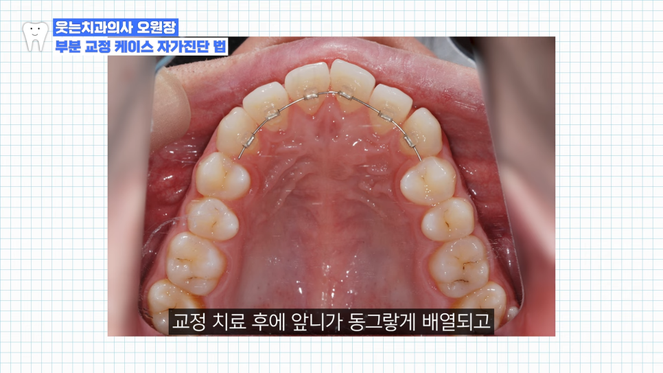 부분교정하고 이렇게 변했습니다 교정 전후 비교 관련 이미지 8