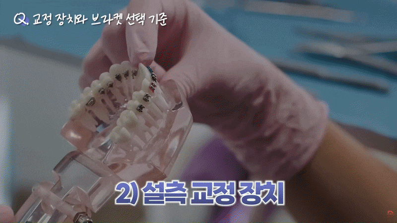 강남 설측교정 장단점, 발음과 위생 관리는 어떨까? 관련 이미지 8