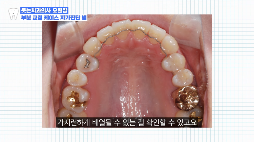 부분교정하고 이렇게 변했습니다 교정 전후 비교 관련 이미지 5