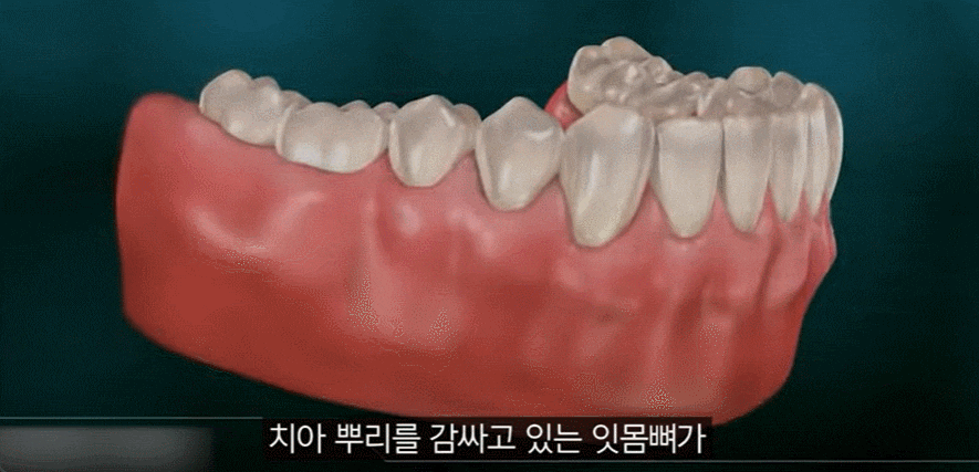 잇몸 염증 원인과 치료법 (치은염, 치주염 전격 분석) 관련 이미지 4