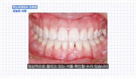 주걱턱 교정 VS 양악수술? 교정과 전문의가 답변드립니다 관련 이미지 14