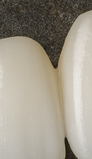 Systematic Examination Process to Review Before Deciding on Front Teeth Laminates image 39