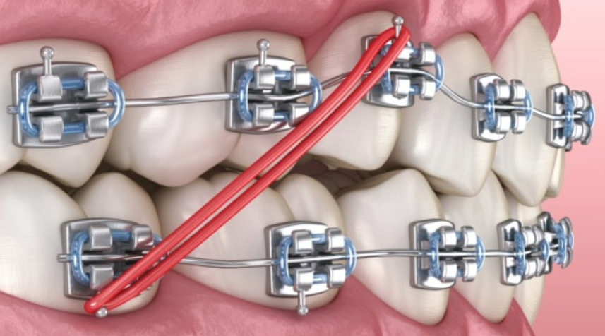 How to Shorten Orthodontic Treatment Time: This Is What Really Matters image 10