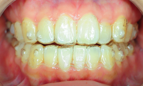 Invisalign Cases: Here’s How Much Can Change Without Brackets image 14