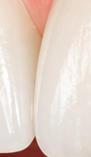 What to Check When Considering No-Prep Laminate Veneers in Gangnam image 39
