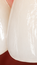 What to Check When Considering No-Prep Laminate Veneers in Gangnam image 38