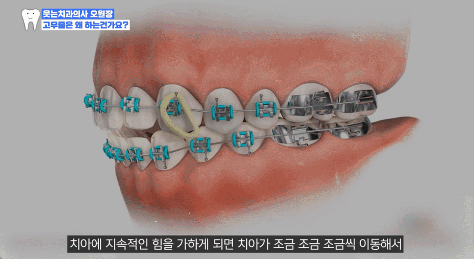 Key Points on the Principles, Duration, and Pain of Orthodontic Rubber Bands, as well as Clear Aligner Costs image 5
