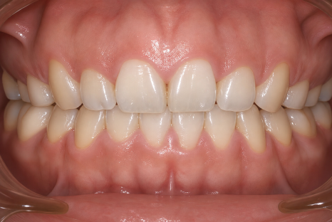 Can Invisalign Correct an Open Bite at a Dental Clinic Near Sinsa Station? image 4