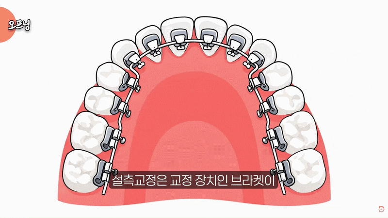 강남 설측교정 장단점, 발음과 위생 관리는 어떨까? 관련 이미지 2
