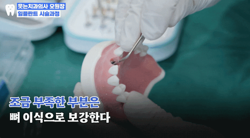 임플란트과정부터 임플란트 치과 고르는 팁까지 A to Z 관련 이미지 13