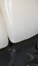 신사역 라미네이트 치과, 자연스러운 미소를 결정짓는 비밀 관련 이미지 39