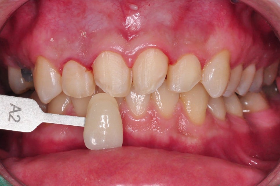Laminates Review? Teeth Whitening? This Is for People Worried About Yellow Teeth image 8