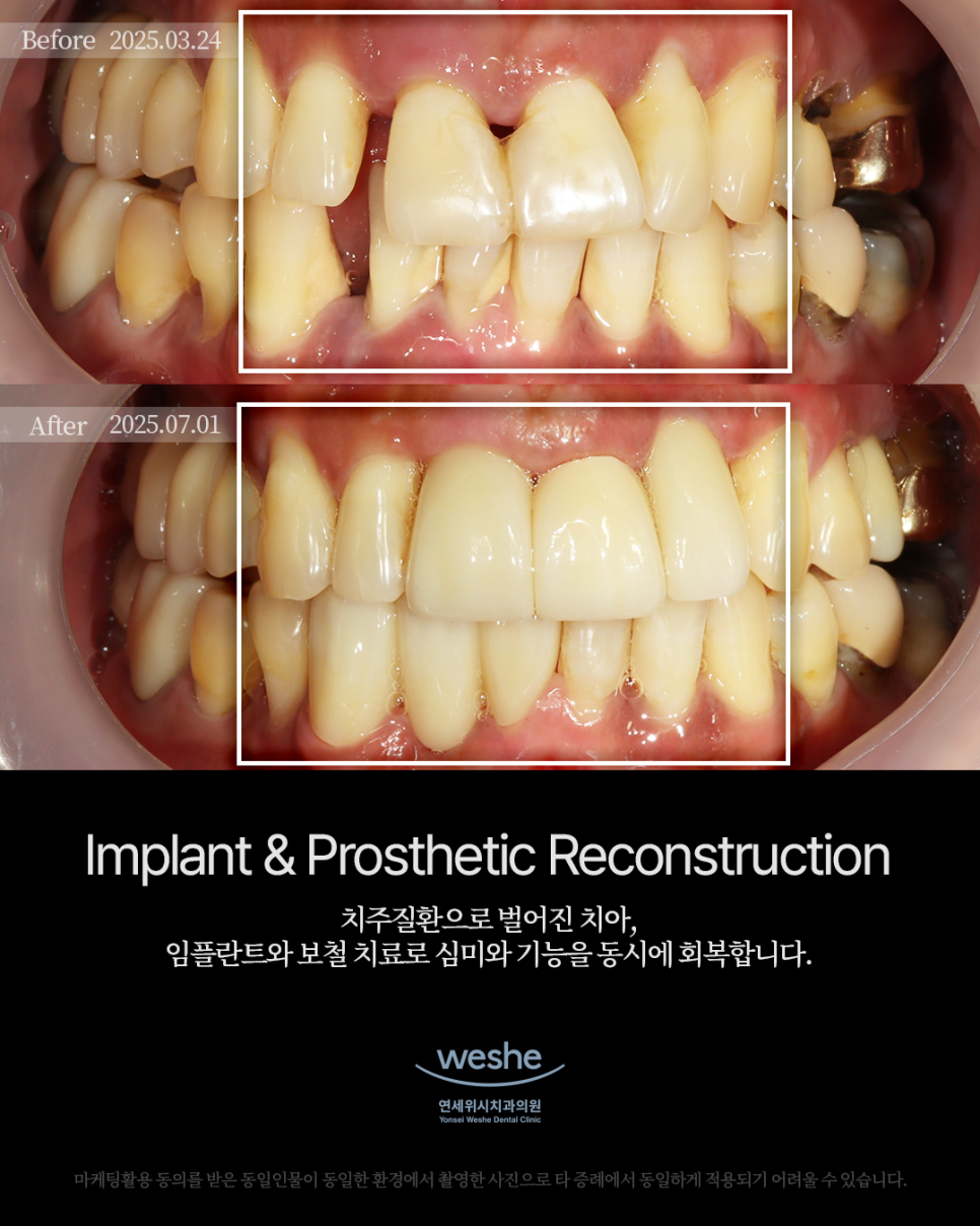 ✨ Esthetic Prosthetic Treatment - Before and After Esthetic Prosthetics and Implant Surgery ✨ image 1
