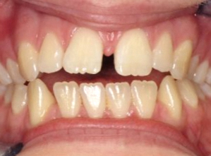 마곡역 치과 "재교정을 하며 6개월을 기다려야 될까요?" 직장인을 위한 앞니 벌어짐 개선 방법 무삭제 라미네이트 관련 이미지 1