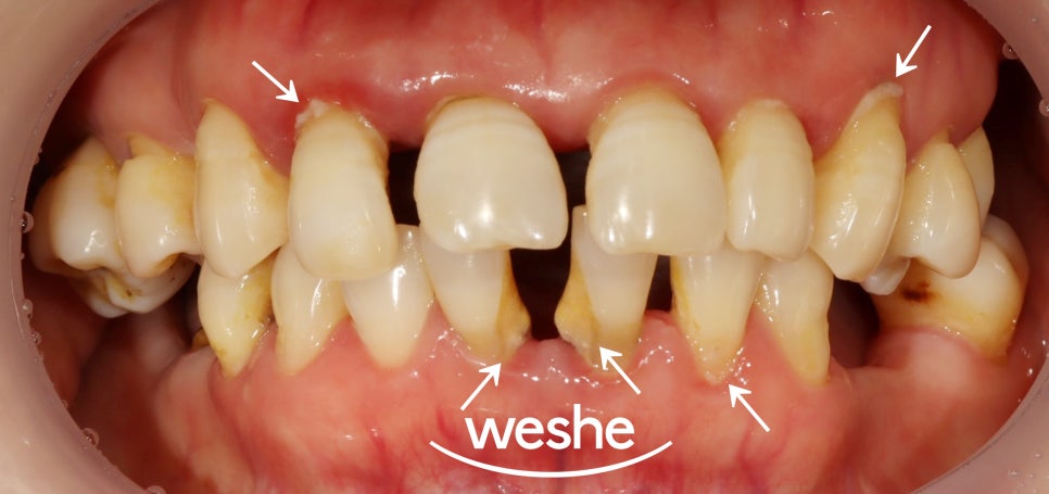 벌어진 치아 사이 (치간이개) 와 치주질환 이 동시에 있을 때, 송정역 치과 임플란트 치료 설명글 관련 이미지 2