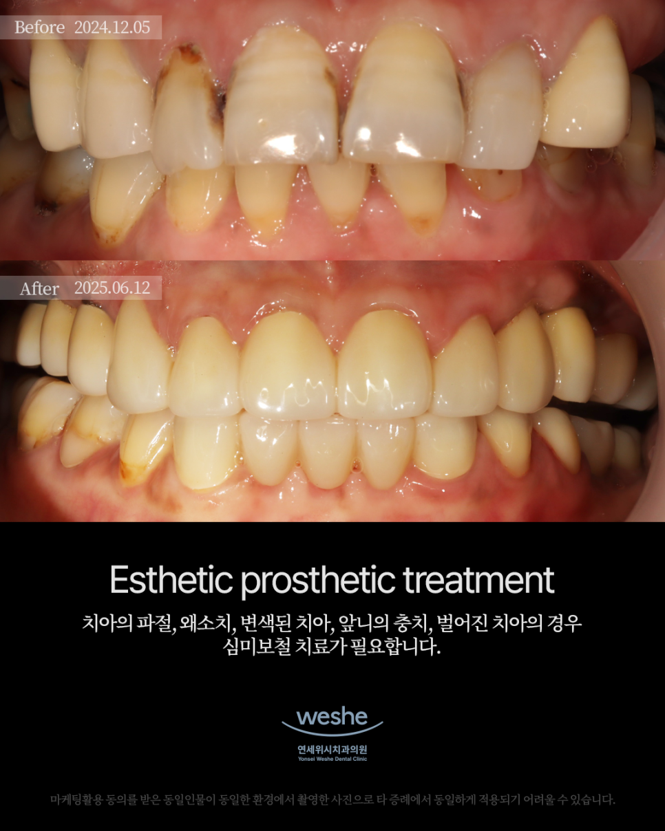 ✨ Esthetic Prosthetic Treatment&ndash; 심미 보철 치료 전후 ✨ 관련 이미지 1