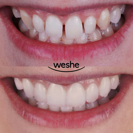 😁 웃을 때 치아 사이 가 벌어져 보인다면? 마곡동 치과 라미네이트 로 해결! 관련 이미지 13