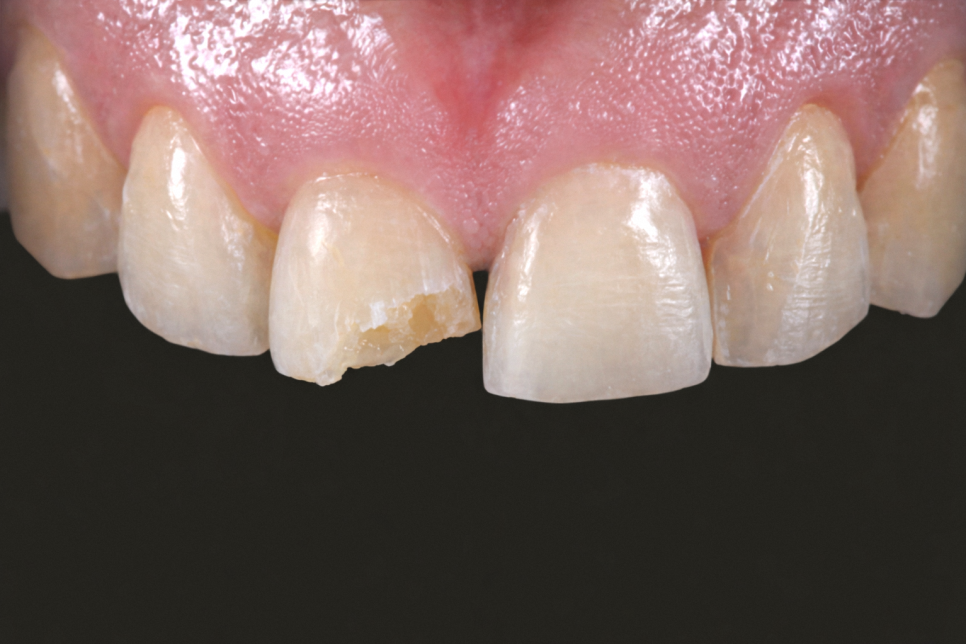 마곡 치과 앞니 깨짐, 레진과 라미네이트 중 무엇이 맞을까? 손상 범위에 따른 치료 방법 관련 이미지 1