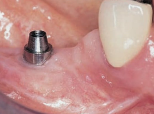 Is a Loose Dental Implant a Sign That Revision Surgery Is Needed? image 6
