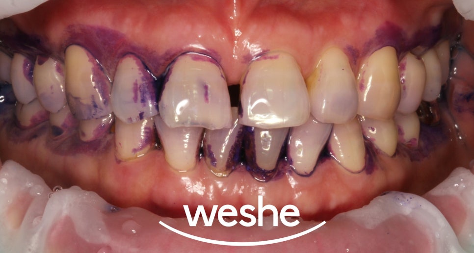 앞니 벌어진 틈, 자연스럽게 해결하는 방법은? 라미네이트 치료 과정을 송정역 치과 에서 소개해 드리도록 하겠습니다. 관련 이미지 3