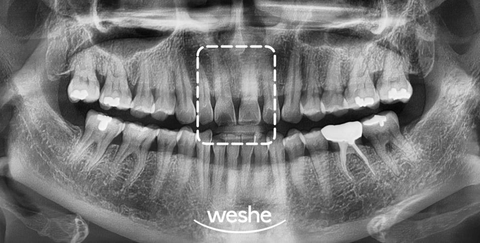 앞니 벌어진 틈, 자연스럽게 해결하는 방법은? 라미네이트 치료 과정을 송정역 치과 에서 소개해 드리도록 하겠습니다. 관련 이미지 2