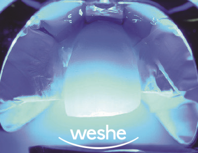 앞니 끝 깨짐 발산 치과 치아 라미네이트 치료 과정 관련 이미지 11