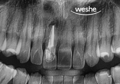 발산 치과 치수 치료 받은 앞니 변색, 왜 크라운이 필요할까? 관련 이미지 1
