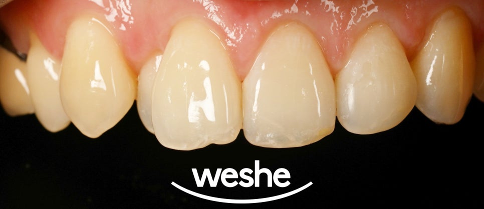 마곡 치과 넘어짐 으로 인한 앞니 치아 끝 살짝 깨짐, 증상에 따라 치료 방법이 달라집니다. 레진 수복 케이스 관련 이미지 4