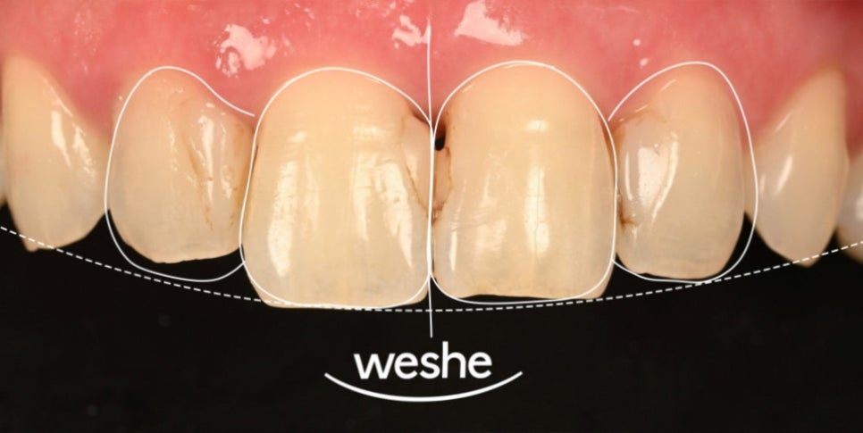 강서구 마곡 치과 벚꽃 시즌 전에 챙기는 심미치료 세 가지 관련 이미지 6
