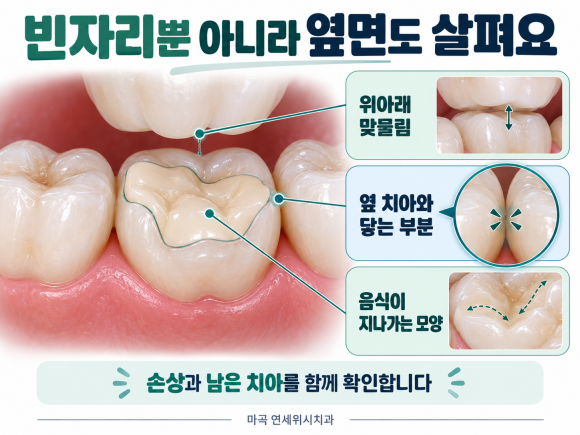 마곡 치아색 충치치료, 레진과 인레이가 다르게 들리는 이유 관련 이미지 4