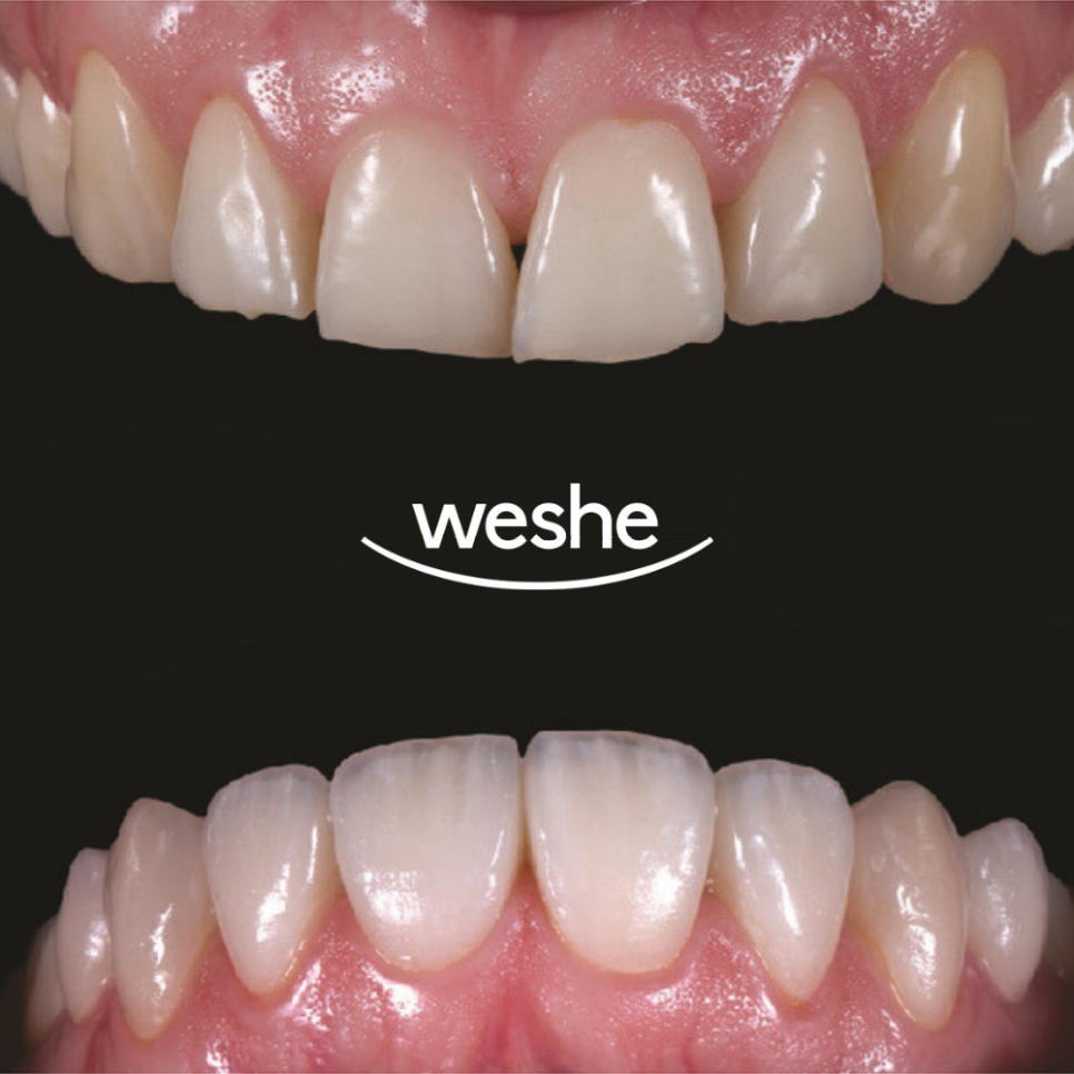 앞니 끝 깨짐 발산 치과 치아 라미네이트 치료 과정 관련 이미지 12