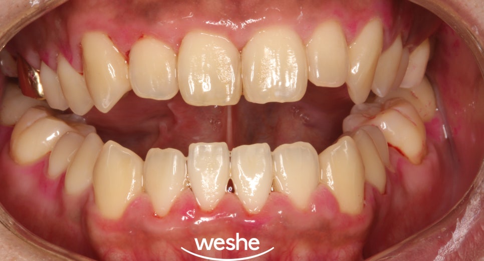 발산 치과 에어플로우 스케일러 를 활용한 치석제거 과정 관련 이미지 10