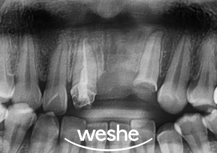 마곡역 치과 잇몸 아래 부러진 치아, 발치 없이 살릴 수 있는 방법은? 교정적 정출술을 동반한 신경치료 관련 이미지 3