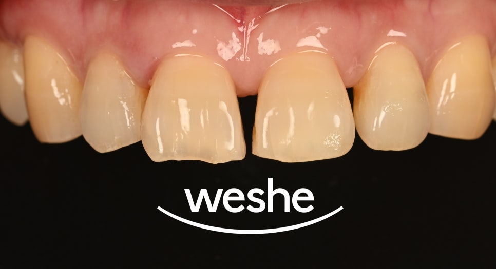 앞니 벌어진 틈, 자연스럽게 해결하는 방법은? 라미네이트 치료 과정을 송정역 치과 에서 소개해 드리도록 하겠습니다. 관련 이미지 5