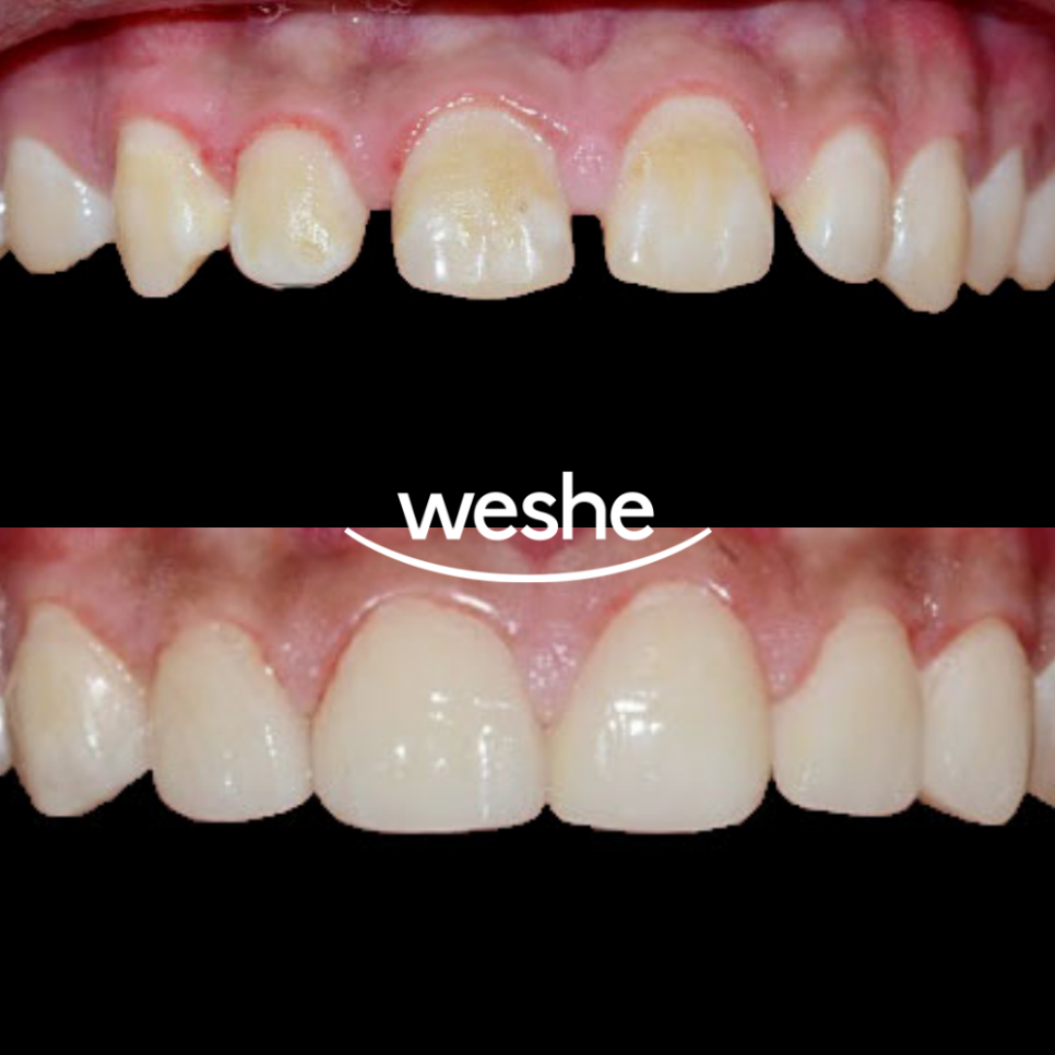 [강서구 치과] 치간이개, 앞니가 벌어졌다?! 치아 벌어짐, 초기 충치/ 라미네이트 치료 과정 관련 이미지 6