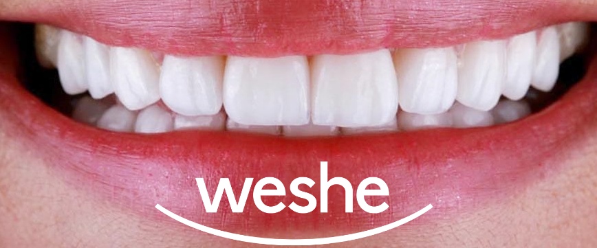 마곡역 치과 삐뚤빼뚤하고 치아 끝 살짝 깨진 앞니, 교정 대신 라미네이트 수복으로 치료 과정 관련 이미지 3