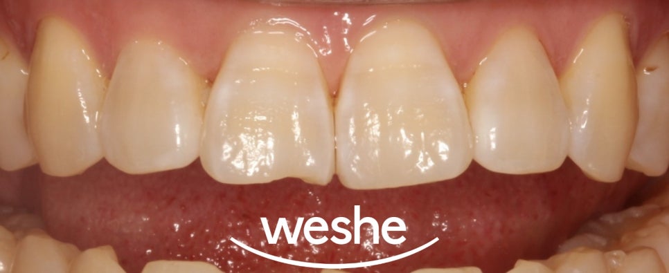 마곡 치과 에서 알려드리는 앞니 끝 깨짐, 치아 파절 레진 치료 방법 관련 이미지 2