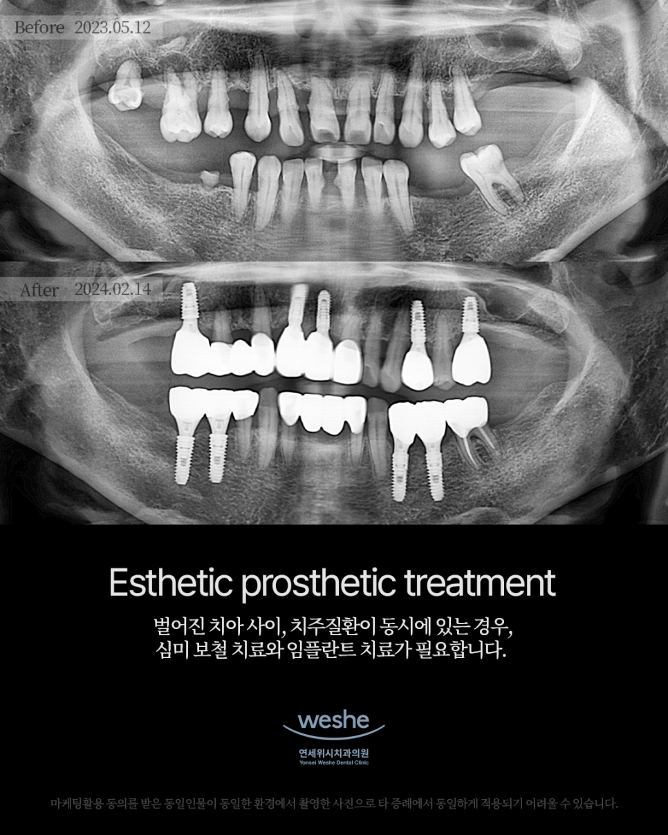 ✨ Esthetic prosthetic treatment - 심미 보철 치료와 임플란트 수술 전후 ✨ 관련 이미지 1