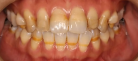 What Does a Conservative Dentistry Specialist Look at First When Considering Laminates? image 2