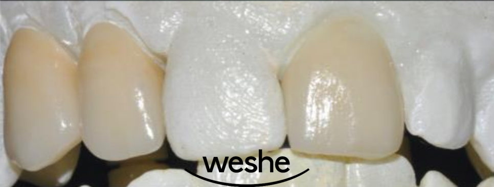 앞니 치아 파절 과 잇몸 염증, 마곡동 치과 의 라미네이트 보철 치료 과정 관련 이미지 3