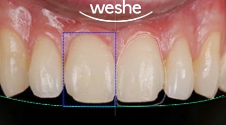마곡 치과 앞니 깨짐! 레진으로는 부족할 때? 라미네이트(Veneer) 치료 과정 관련 이미지 2