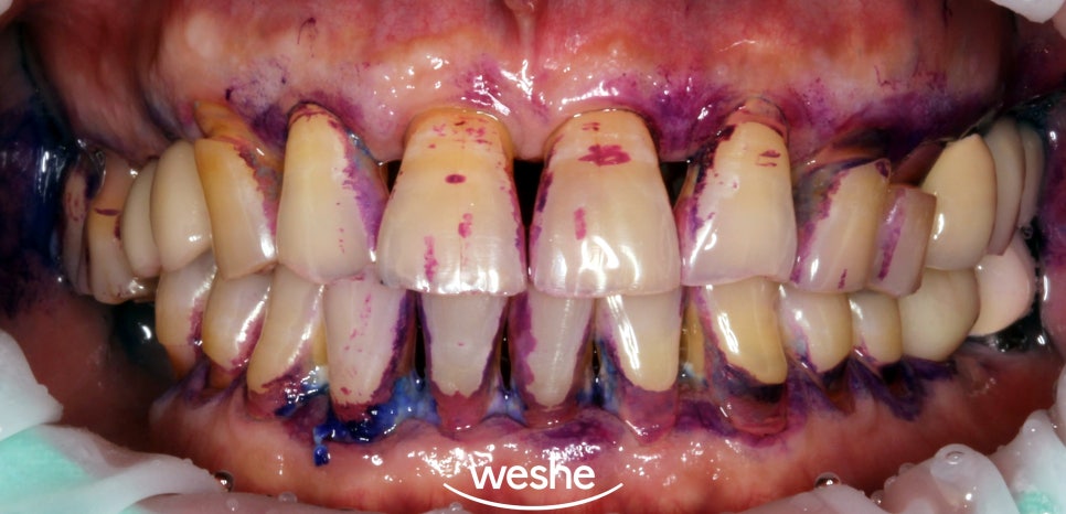 마곡역 치과 구강 관리의 기초는? 칫솔질, 스케일링, 잇몸치료의 중요성 관련 이미지 2