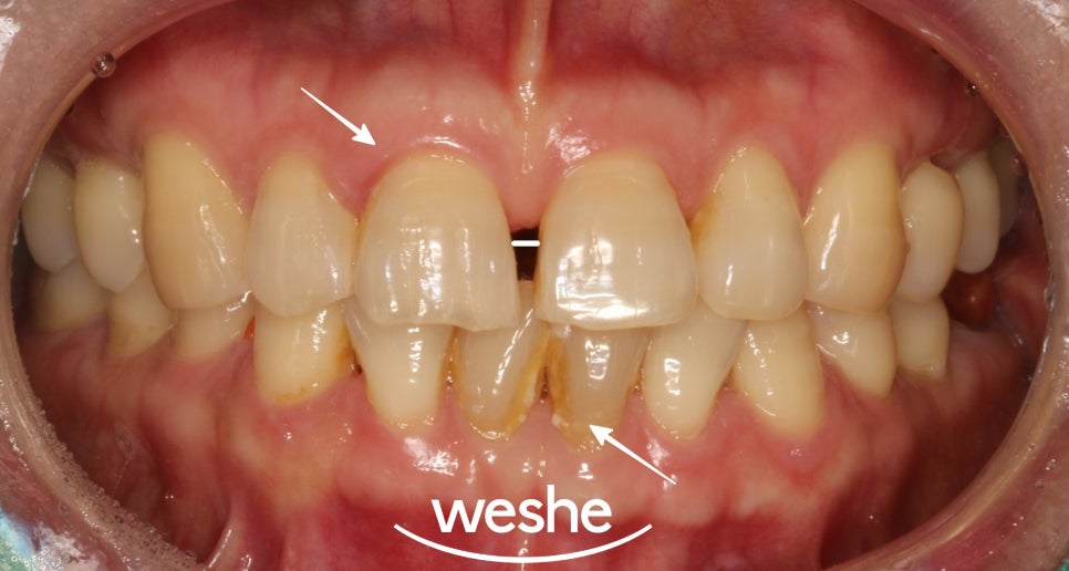 앞니 벌어진 틈, 자연스럽게 해결하는 방법은? 라미네이트 치료 과정을 송정역 치과 에서 소개해 드리도록 하겠습니다. 관련 이미지 1