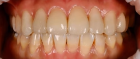 What Does a Conservative Dentistry Specialist Look at First When Considering Laminates? image 3