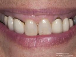 강서구 마곡동 치과 잇몸 경계의 검은 선, 지르코니아 크라운 으로 지울 수 있을까? 관련 이미지 4