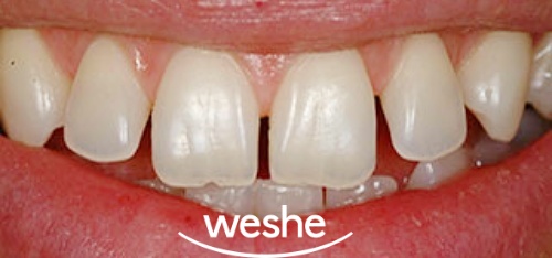 송정역 치과 치간이개(앞니 사이 벌어짐)의 원인과 해결법, 라미네이트 수복 과정 정리 관련 이미지 1