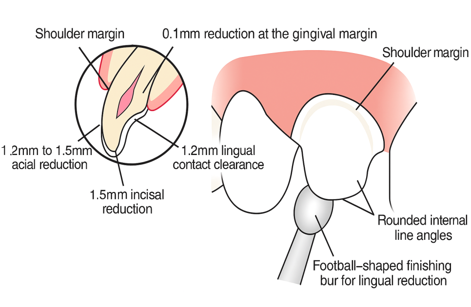 마곡 치과 에서 알려드리는 앞니 끝 깨짐, 치아 파절 레진 치료 방법 관련 이미지 5