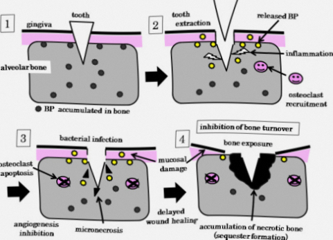 강서구 마곡 치과 [전신질환 임플란트] 골다공증 환자를 위한 안전 수술 가이드 관련 이미지 2